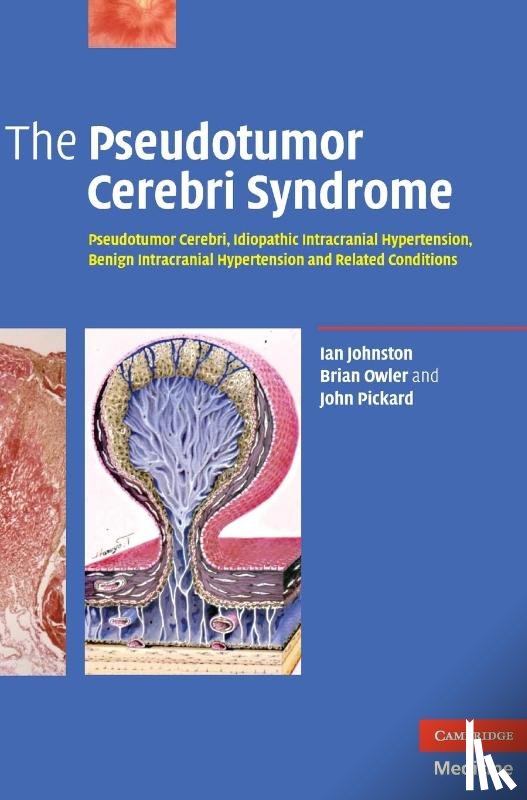 Johnston, Ian (University of Sydney), Owler, Brian, Pickard, John (University of Cambridge) - The Pseudotumor Cerebri Syndrome