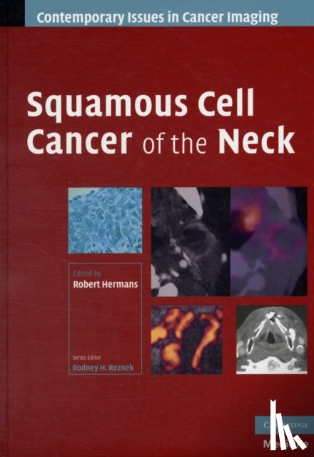  - Squamous Cell Cancer of the Neck