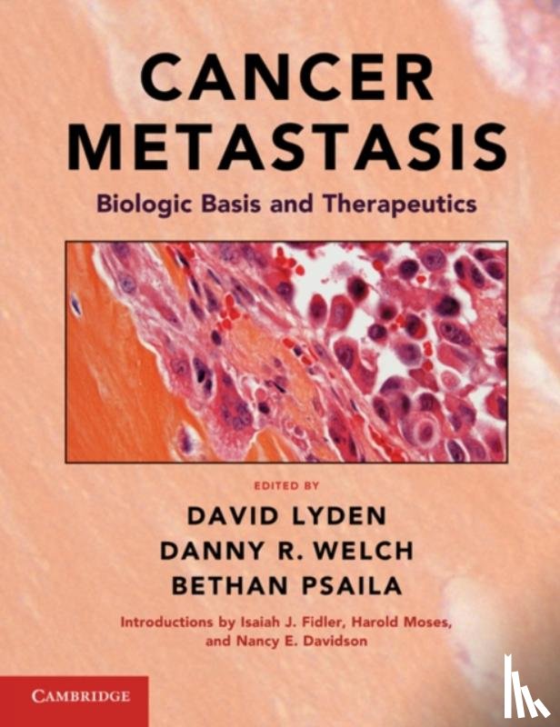  - Cancer Metastasis