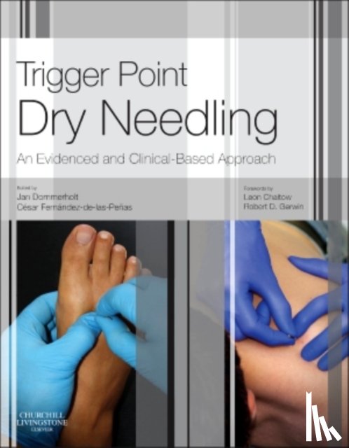  - Trigger Point Dry Needling