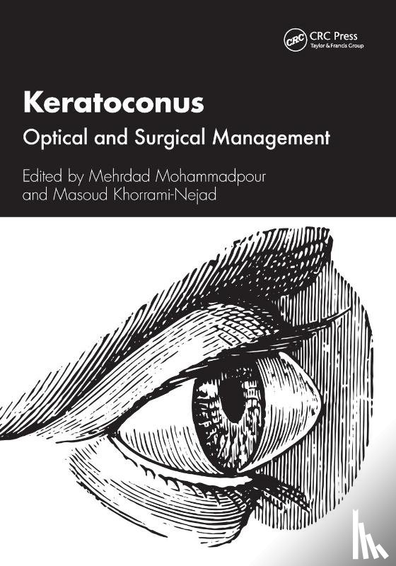  - Keratoconus