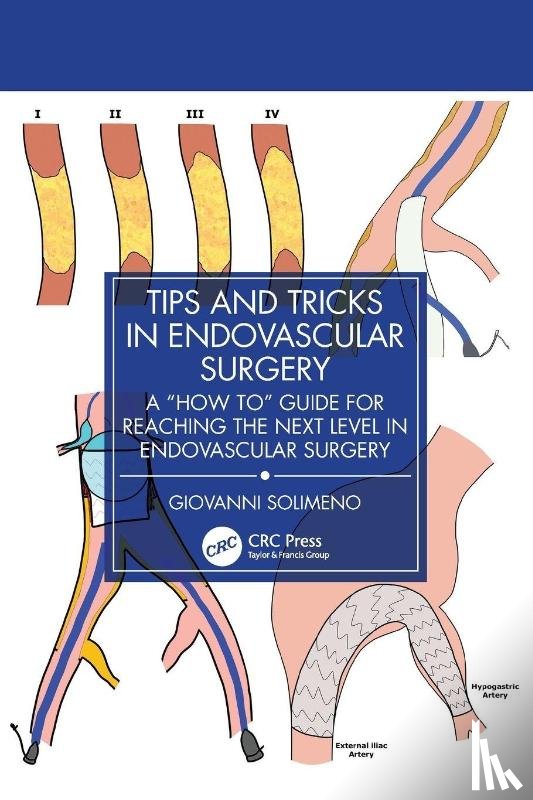 Solimeno, Giovanni - Tips and Tricks in Endovascular Surgery