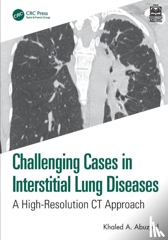 Abuzeid, Khaled A. - Challenging Cases in Interstitial Lung Diseases