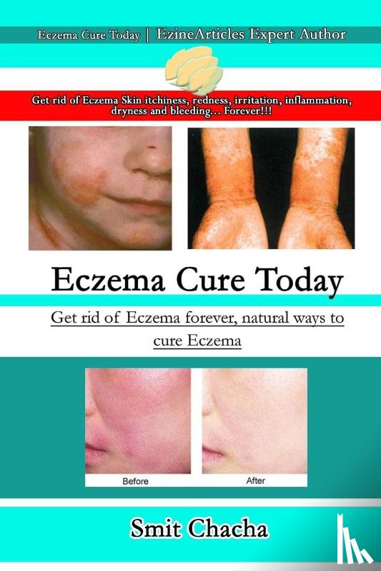 Chacha, Smit - Eczema Cure Today - Get rid of Eczema forever natural ways to cure Eczema