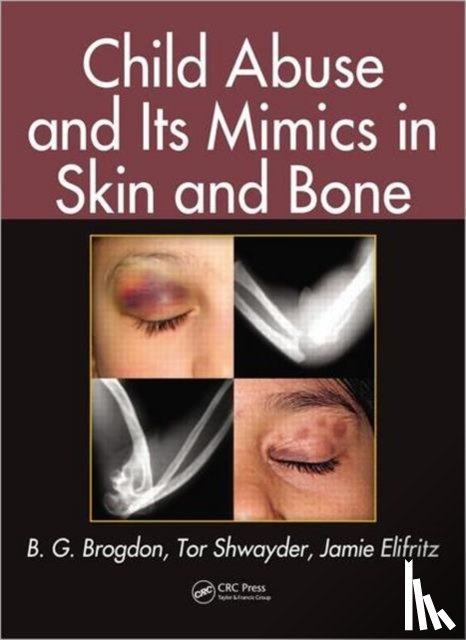 Brogdon, B. G. (University of South Alabama, Shwayder, Tor (Henry Ford Hospital, Elifritz, Jamie (University of New Mexico - Child Abuse and its Mimics in Skin and Bone