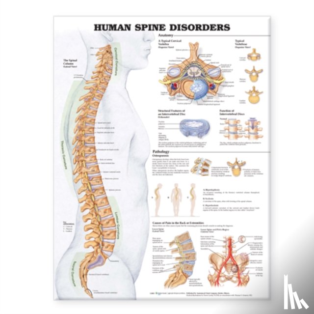 Anatomical Chart Company - Human Spine Disorders Anatomical Chart