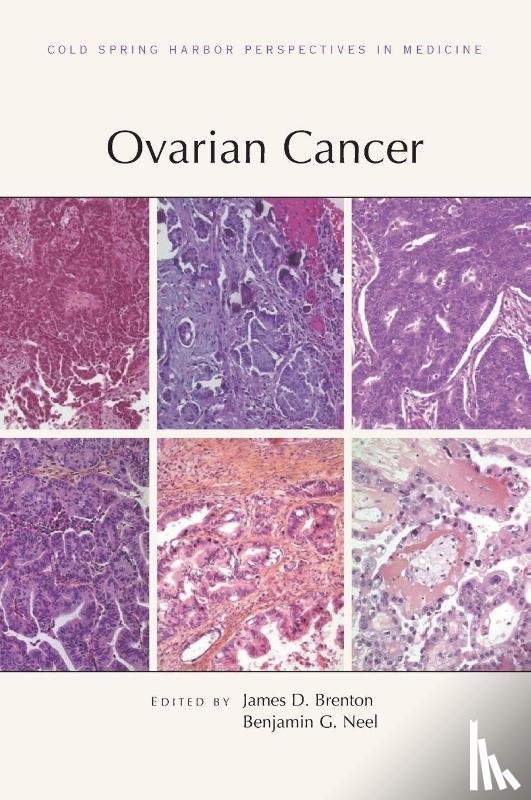 Brenton, James D, Neel, Benjamin G - Ovarian Cancer