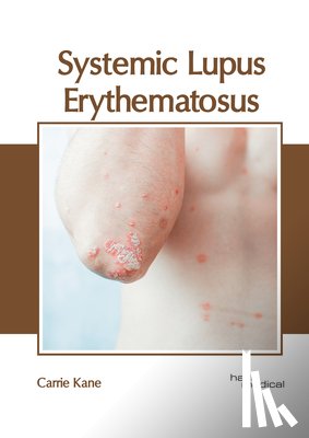  - Systemic Lupus Erythematosus