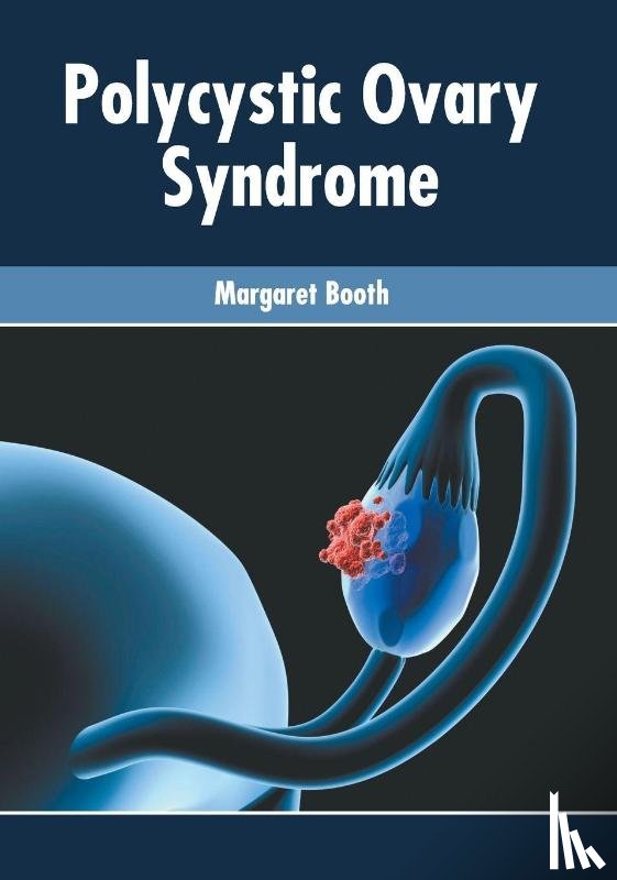  - Polycystic Ovary Syndrome