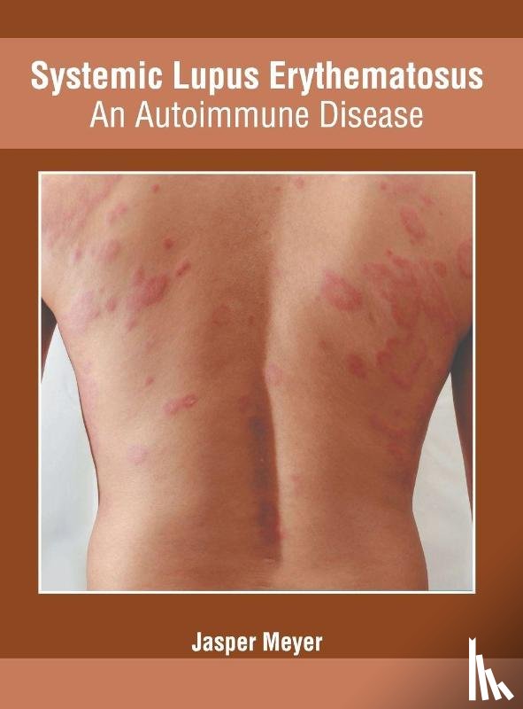  - Systemic Lupus Erythematosus: An Autoimmune Disease