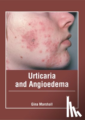  - Urticaria and Angioedema
