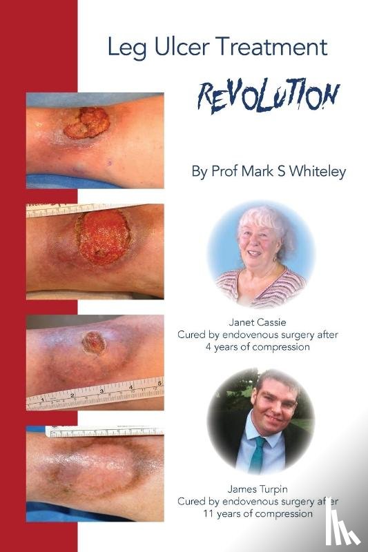 Whiteley, Mark - Leg Ulcer Treatment Revolution