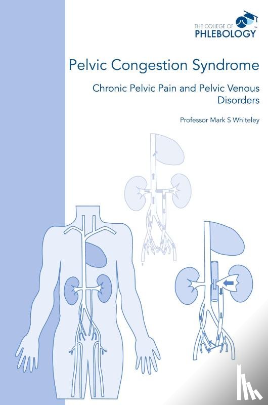 Whiteley, Mark S - Pelvic Congestion Syndrome - Chronic Pelvic Pain and Pelvic Venous Disorders