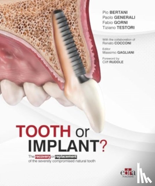 Generali, Paolo, Gorni, Fabio, Testori, Tiziano - Tooth or Implant