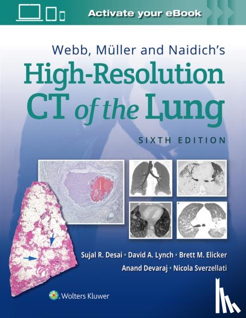 Desai, Sujal, Lynch, David, Elicker, Brett M, MD, Devaraj, Anand - Webb, Muller and Naidich's High-Resolution CT of the Lung