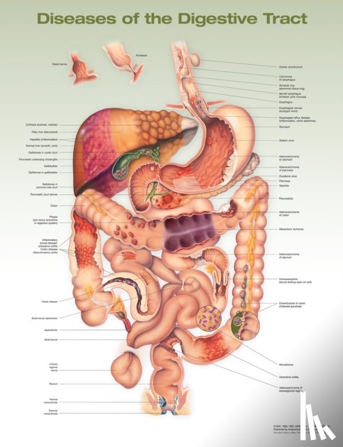 Anatomical Chart Company - Diseases of the Digestive Tract Anatomical Chart