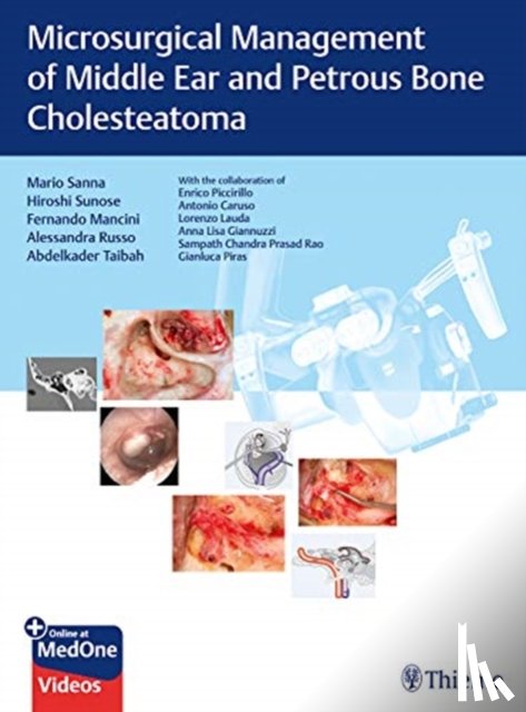 Sanna, Mario, Sunose, Hiroshi, Mancini, Fernando, Russo, Alessandra - Microsurgical Management of Middle Ear and Petrous Bone Cholesteatoma