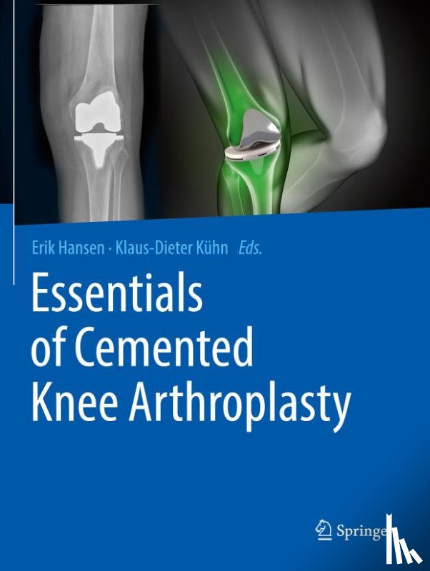  - Essentials of Cemented Knee Arthroplasty