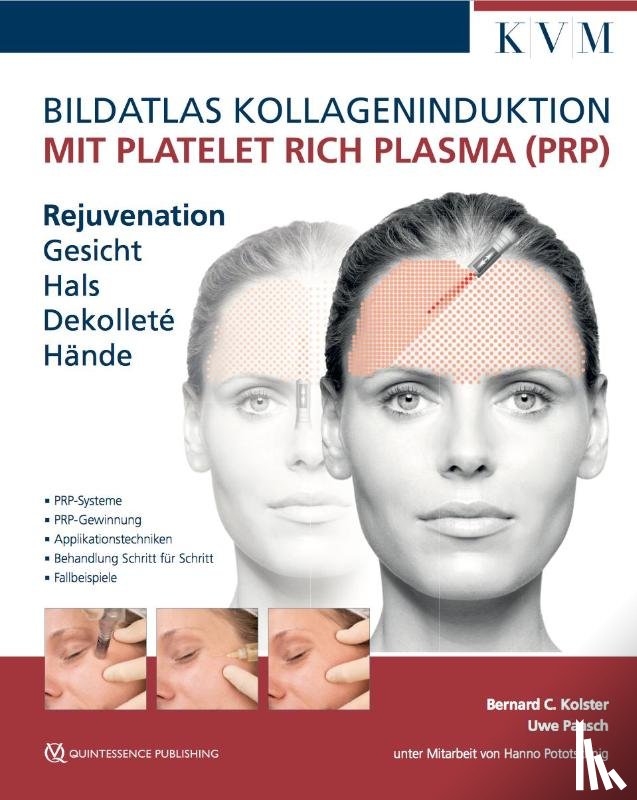 Paasch, Uwe, Kolster, Bernard C. - Bildatlas Kollageninduktion mit Platelet Rich Plasma (PRP)