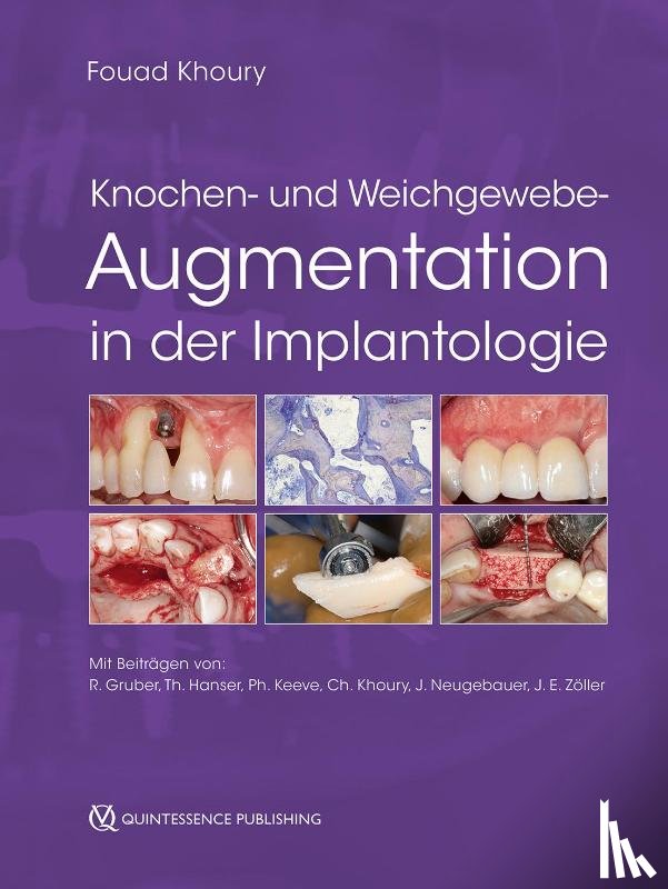  - Knochen- und Weichgewebeaugmentation in der Implantologie