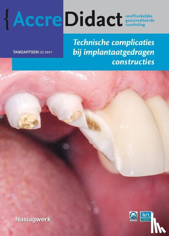 Avoort, Gordon van der - Technische complicaties bij implantaatgedragen constructies