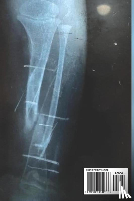 Raiza Moreno - Raiza Moreno: Pseudoartrosis congenita