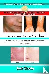 Chacha, Smit - Eczema Cure Today - Get rid of Eczema forever natural ways to cure Eczema