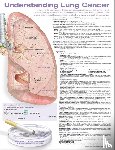  - Understanding Lung Cancer Anatomical Chart